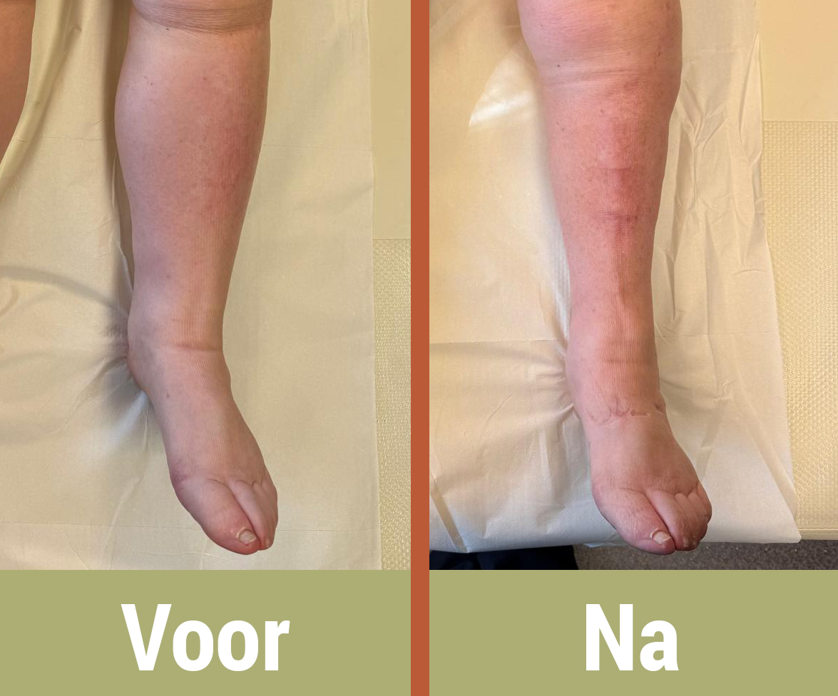 Oedeemtherapie, Lymfoedeem in been; voor en na behandeling