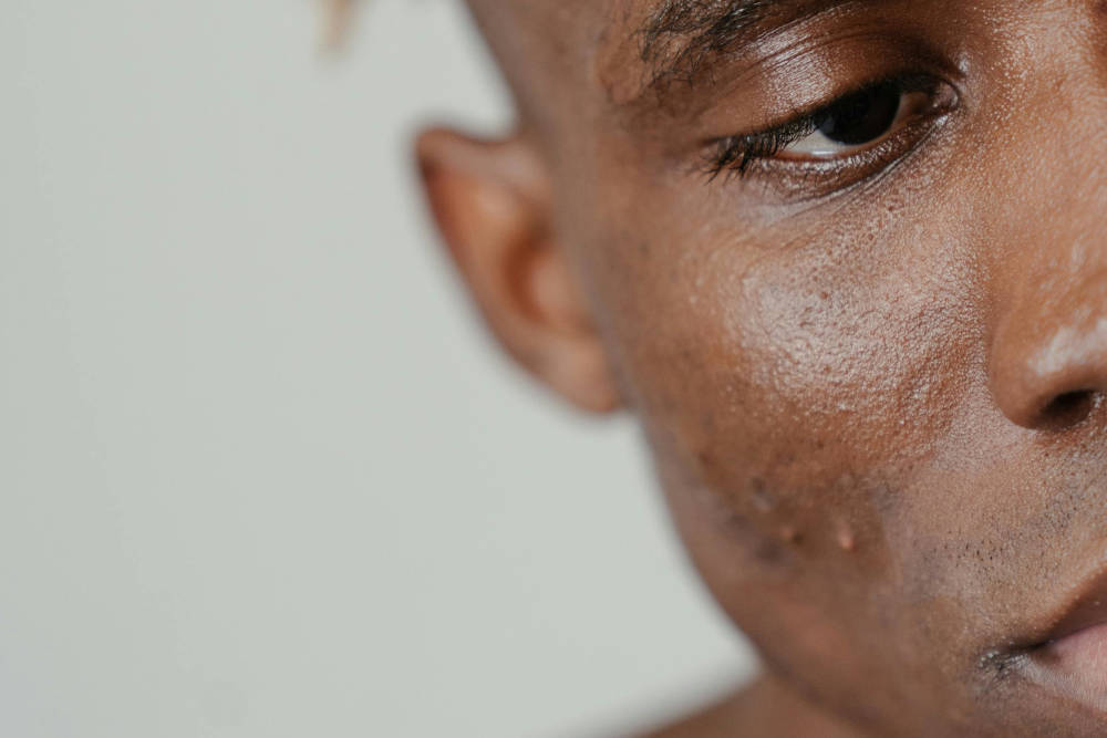 Acnebehandelingen Huidtherapie Els Stijkel