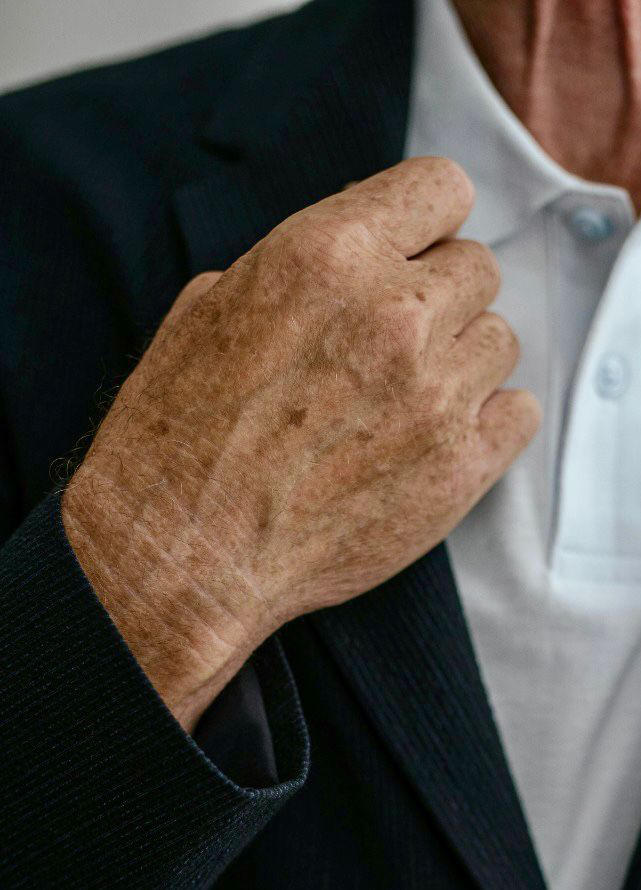 Huidtherapie Els Stijkel voor ouderdomsvlekken